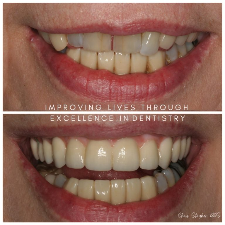 Implant Dentistry - Lincoln Crossings Dental Care