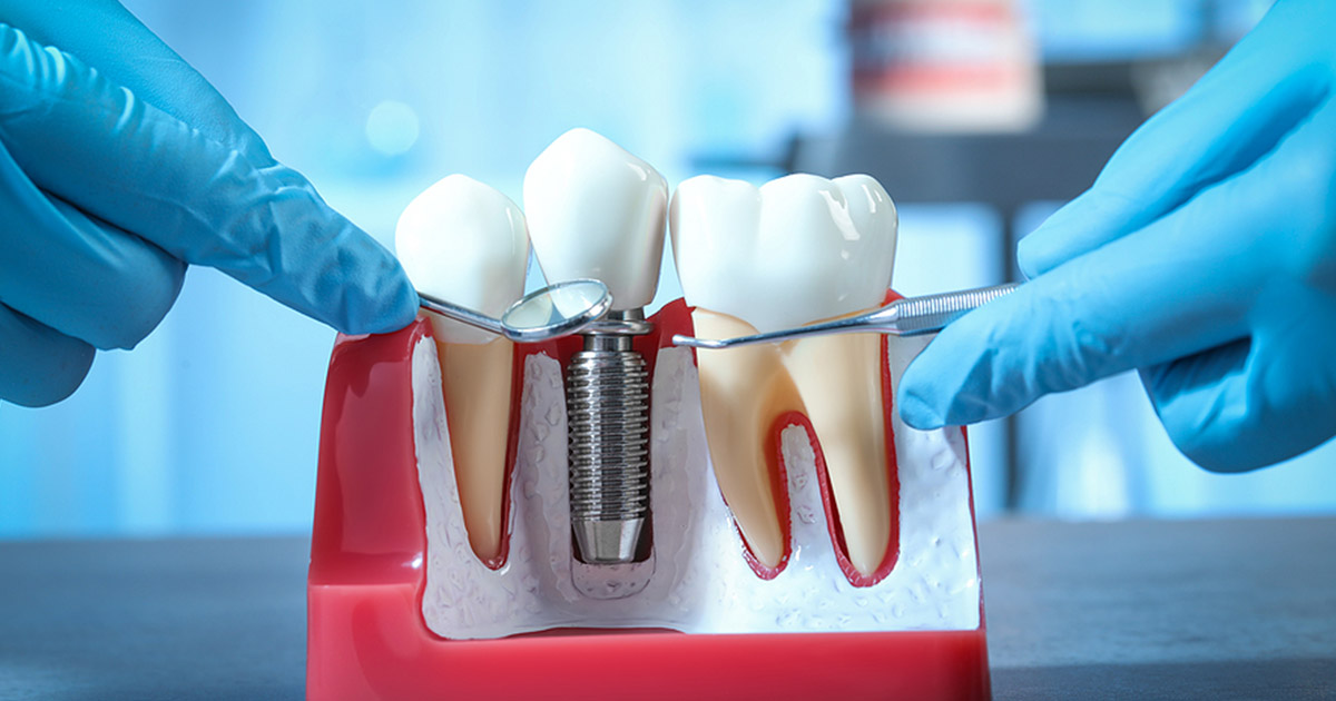 Single Implant / Implant Bridges - Lincoln Crossings Dental Care